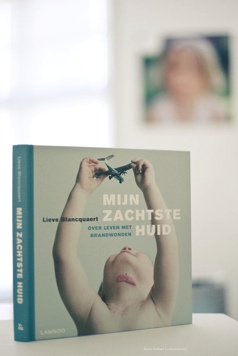 Mijn zachtste huid â€“ Over leven met brandwonden, fototentoonstelling en boek van Lieve Blancquaert, Gent, BE, 19/09/-11/10/2009